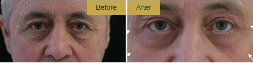Non surgical blepharoplasty results