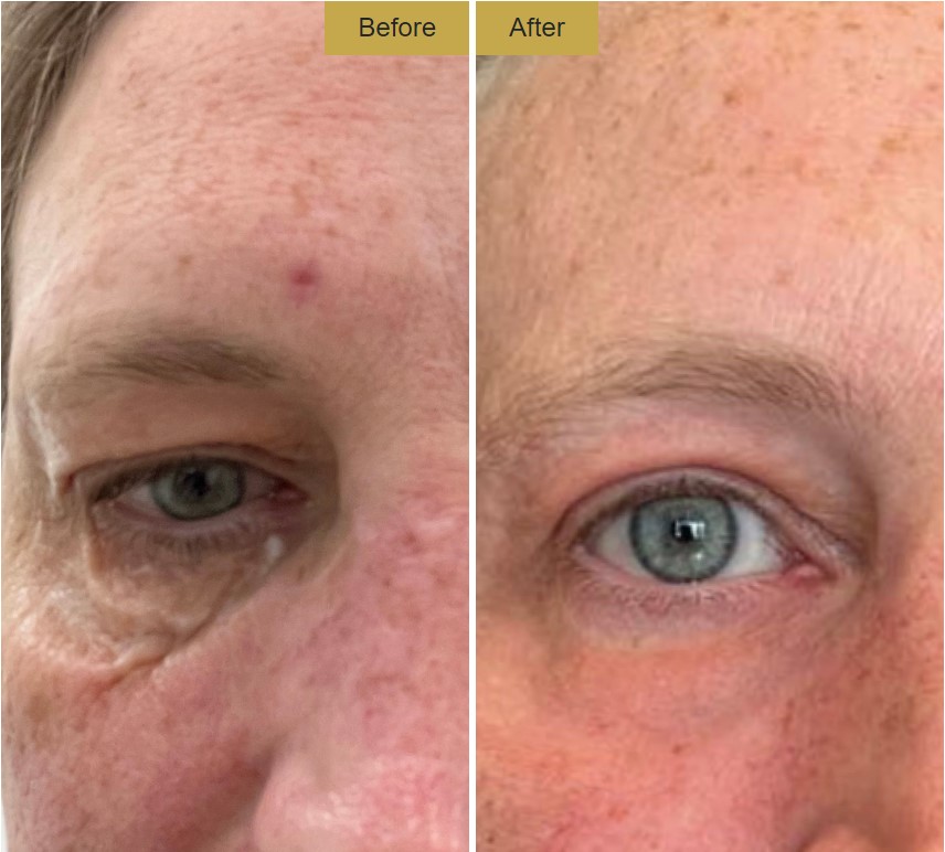 non surgical blepharoplasty results